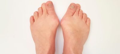 外反母趾　女性